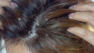 Fights Dandruff and Dry Scalp