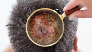Prevents and Treats Scalp Infections