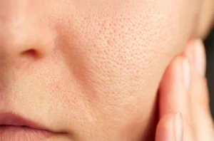 Improves Skin Texture and Tightens Pores