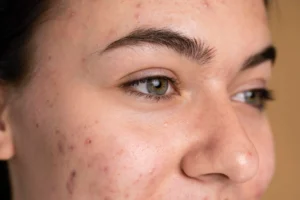 Reduces Pigmentation and Dark Spots